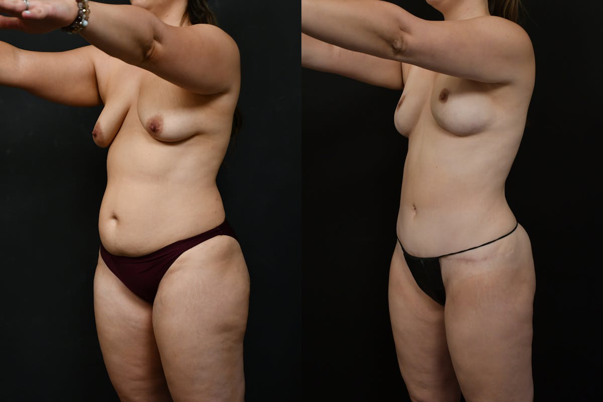 Tummy Tuck Before & After Gallery - Patient 231062 - Image 2