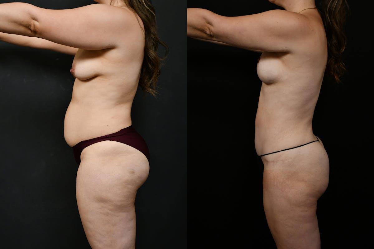 Tummy Tuck Before & After Gallery - Patient 231062 - Image 3