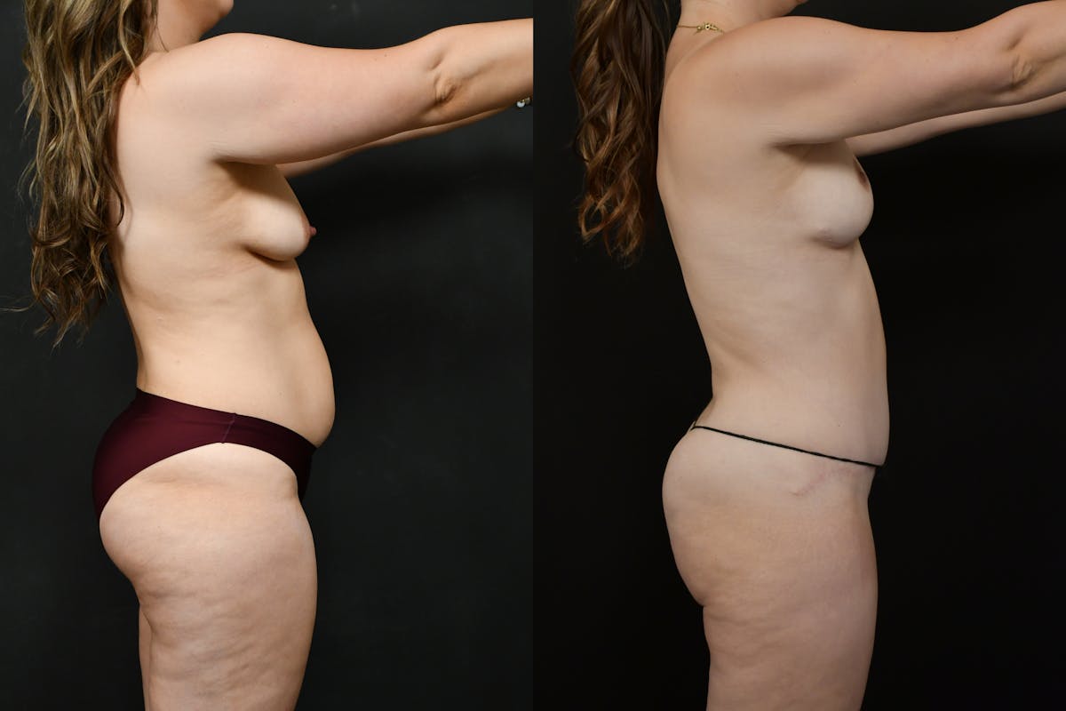 Tummy Tuck Before & After Gallery - Patient 231062 - Image 6