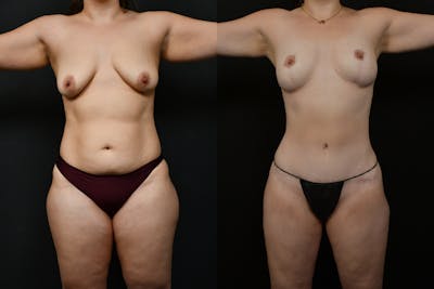 Tummy Tuck Before & After Gallery - Patient 231062 - Image 1