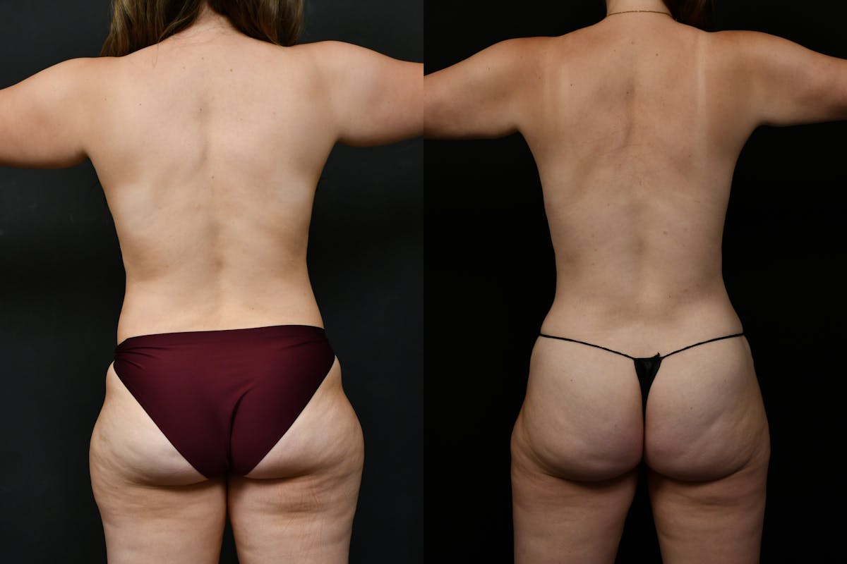 Tummy Tuck Before & After Gallery - Patient 231062 - Image 4