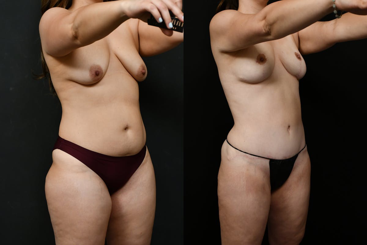 Tummy Tuck Before & After Gallery - Patient 231062 - Image 5