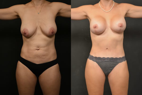 Reductive Augmentation Before & After Gallery - Patient 106946 - Image 1