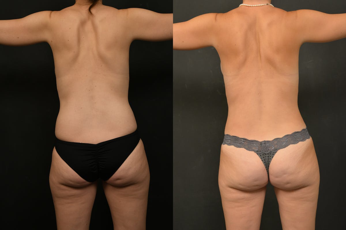 Reductive Augmentation Before & After Gallery - Patient 106946 - Image 4