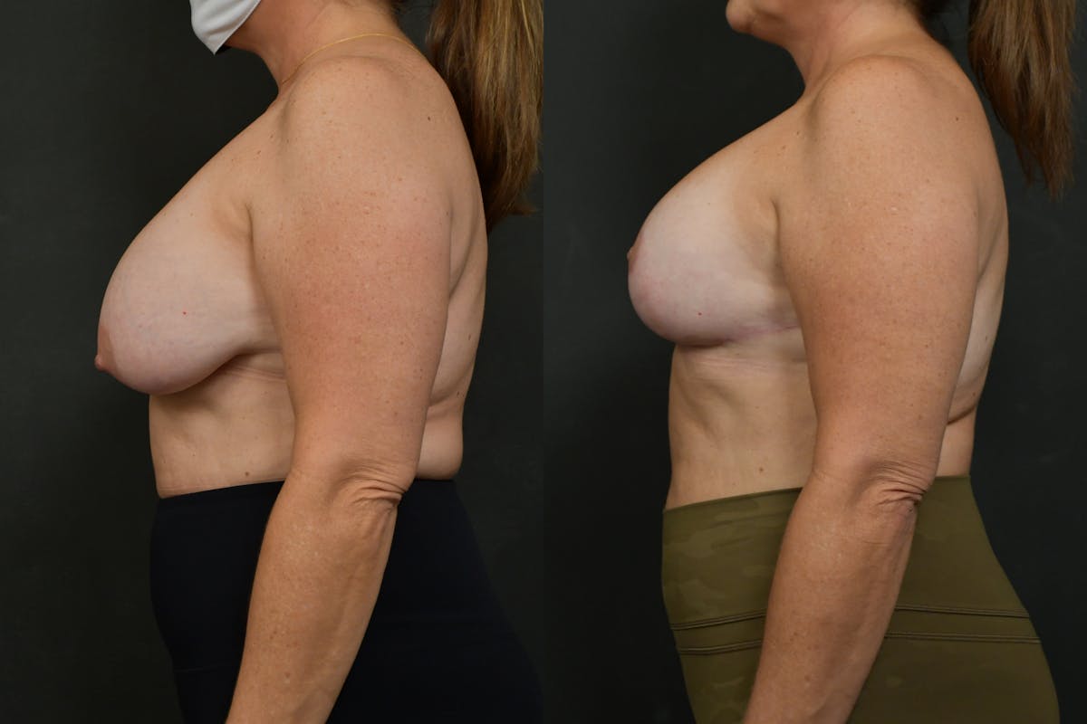 Reductive Augmentation Before & After Gallery - Patient 969378 - Image 5
