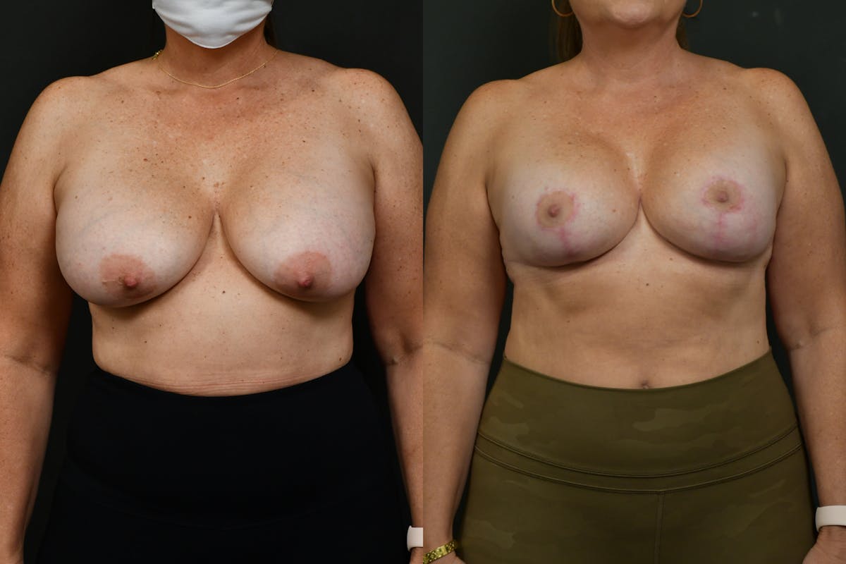 Reductive Augmentation Before & After Gallery - Patient 969378 - Image 1