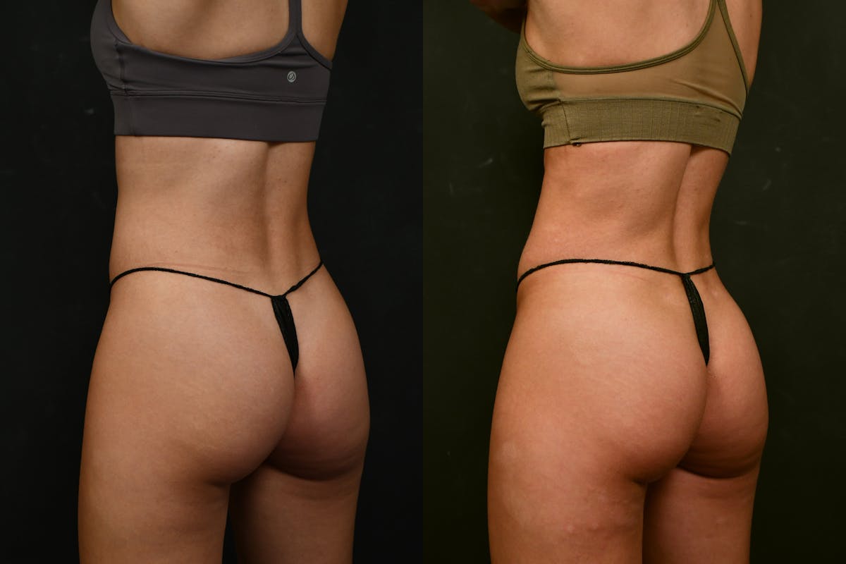 Liposuction / BodyTite Before & After Gallery - Patient 413202 - Image 3
