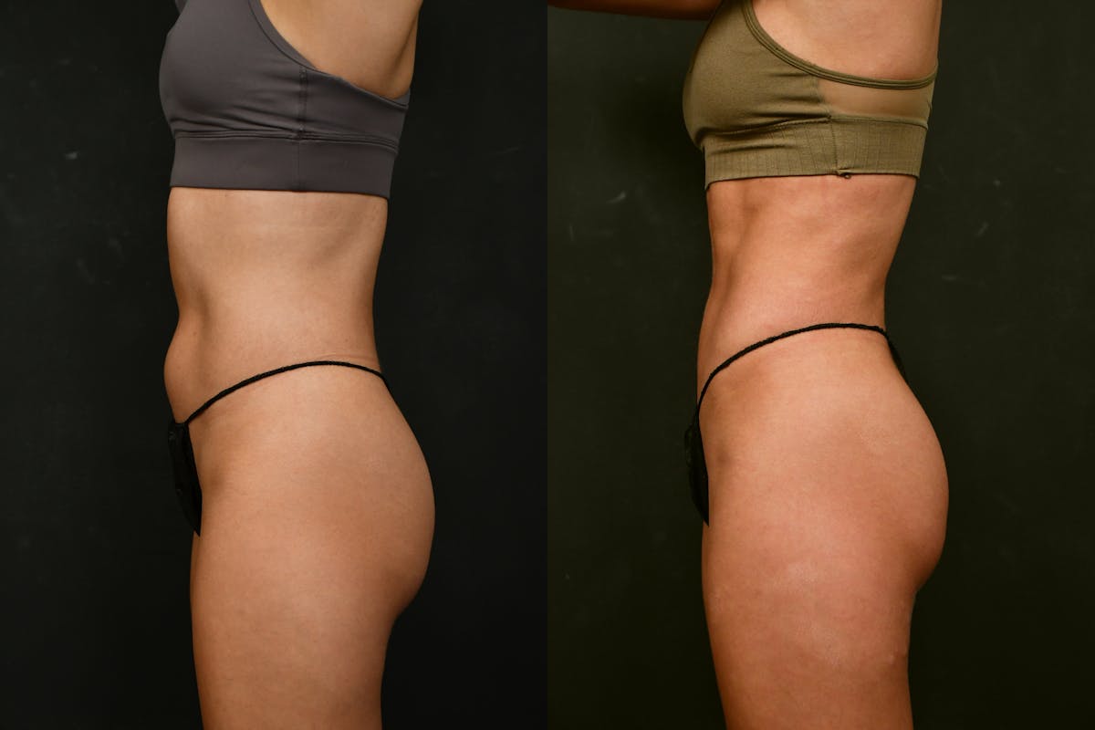 Liposuction / BodyTite Before & After Gallery - Patient 413202 - Image 2