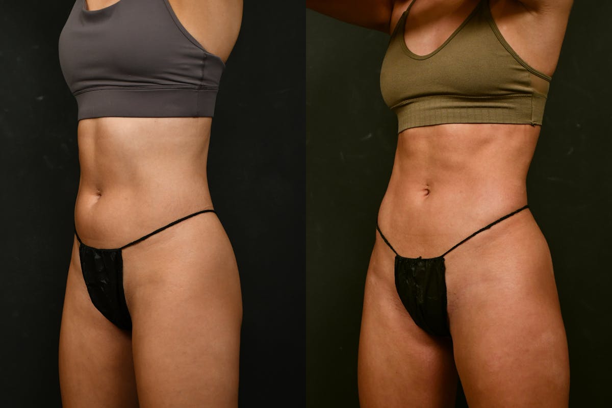 Liposuction / BodyTite Before & After Gallery - Patient 413202 - Image 7