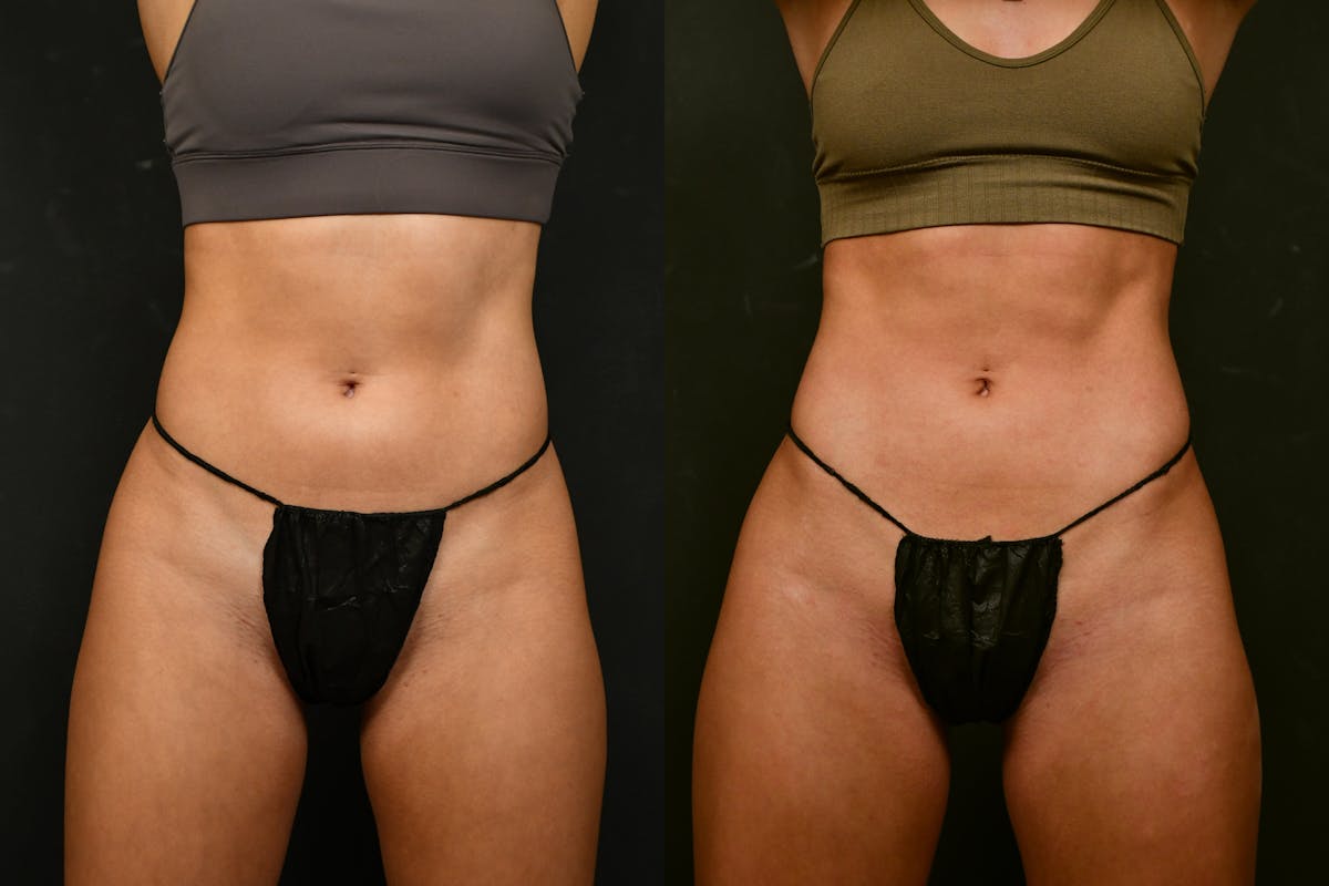Liposuction / BodyTite Before & After Gallery - Patient 413202 - Image 1