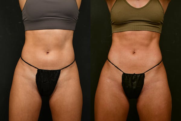 Liposuction / BodyTite Before & After Gallery - Patient 413202 - Image 1