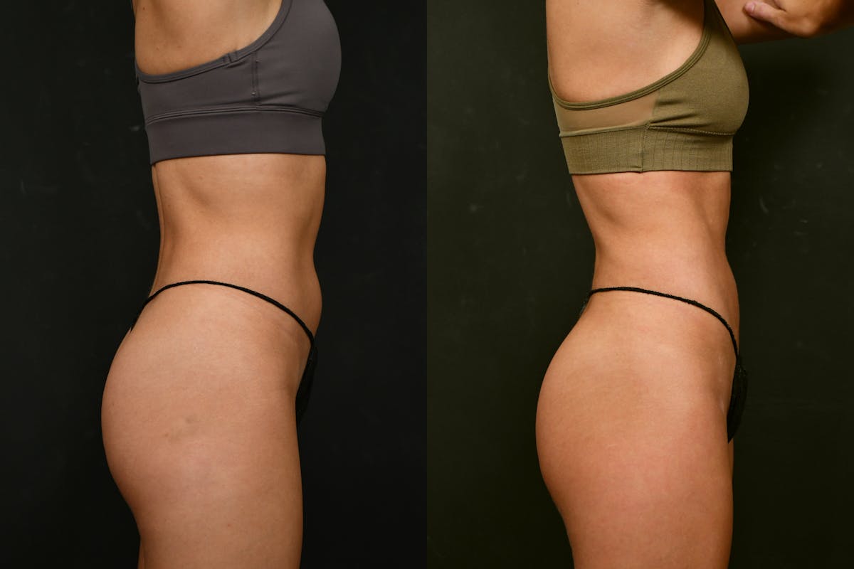 Liposuction / BodyTite Before & After Gallery - Patient 413202 - Image 8