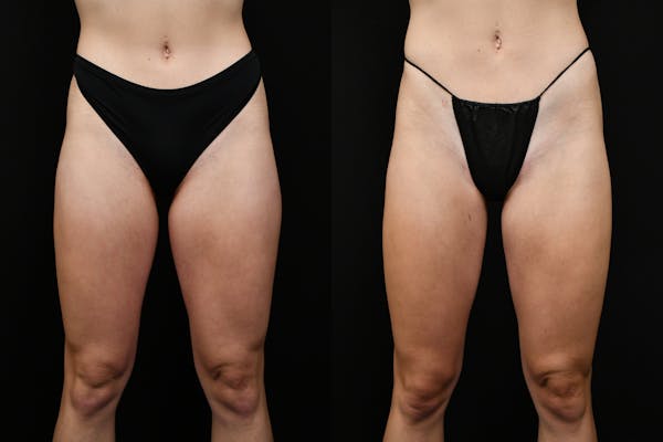 Liposuction / BodyTite Before & After Gallery - Patient 347861 - Image 1