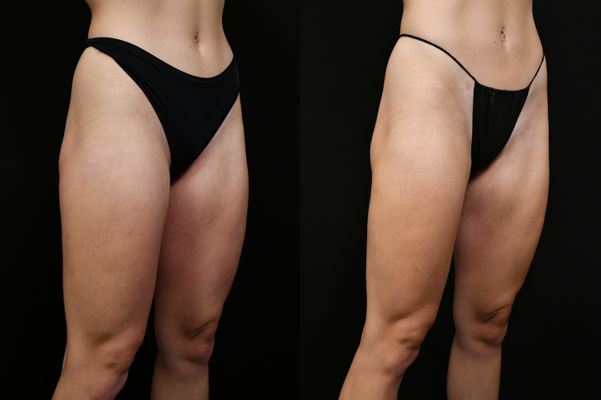 Liposuction / BodyTite Before & After Gallery - Patient 347861 - Image 3