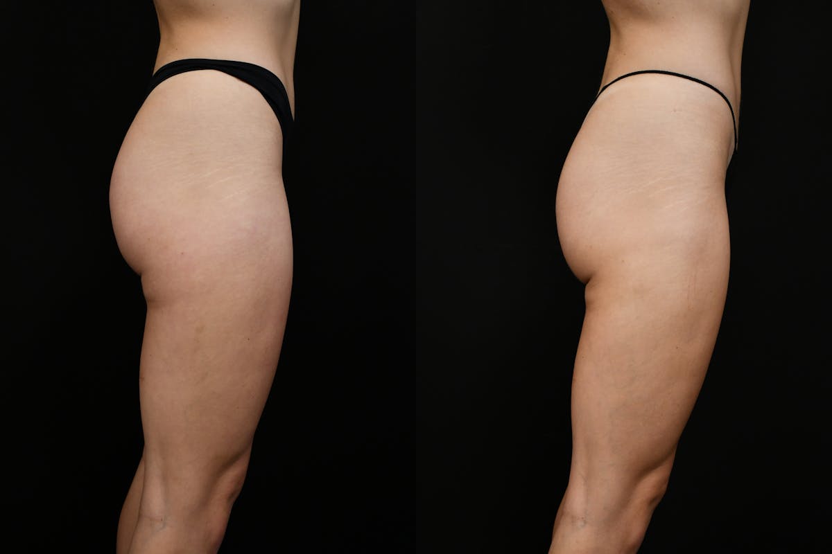Liposuction / BodyTite Before & After Gallery - Patient 347861 - Image 2