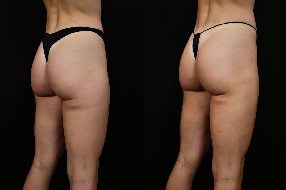 Liposuction / BodyTite Before & After Gallery - Patient 347861 - Image 4