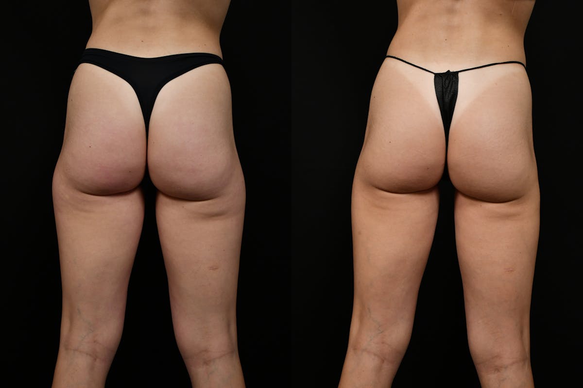 Liposuction / BodyTite Before & After Gallery - Patient 347861 - Image 5