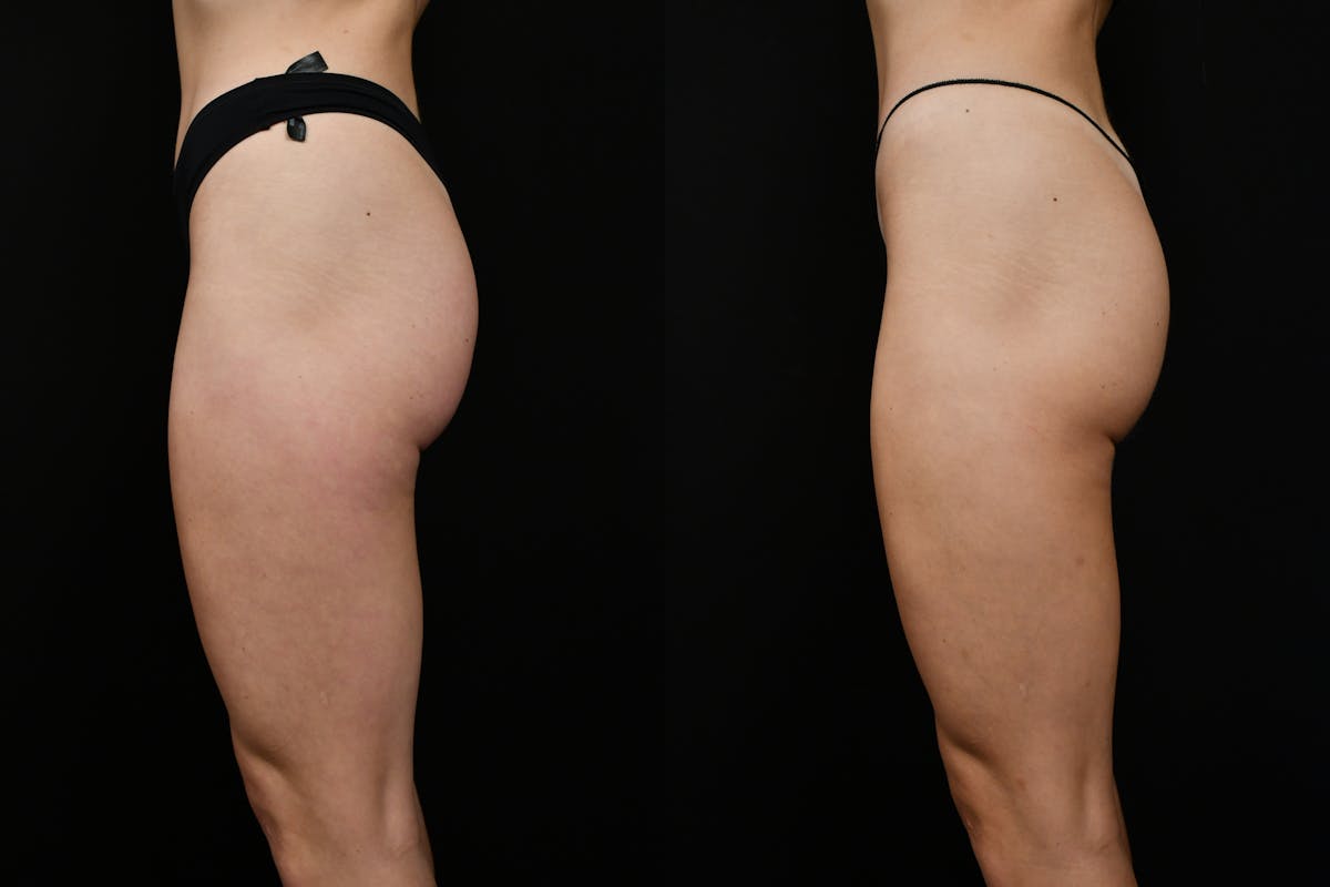 Liposuction / BodyTite Before & After Gallery - Patient 347861 - Image 6