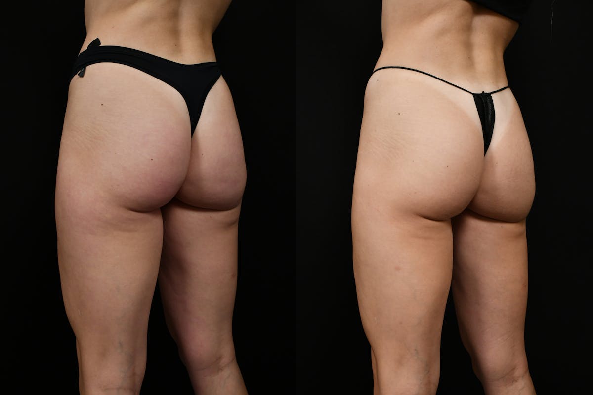 Liposuction / BodyTite Before & After Gallery - Patient 347861 - Image 7