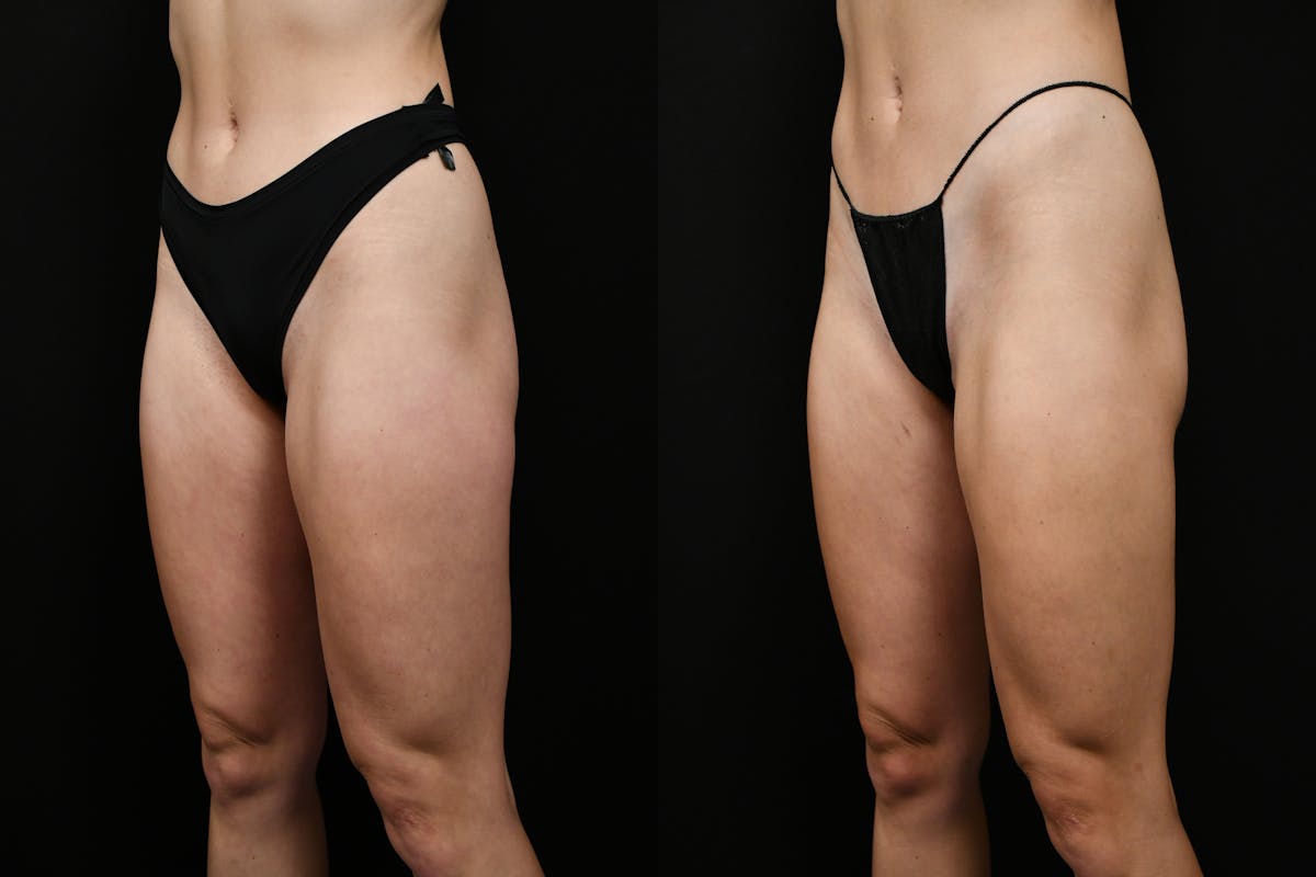 Liposuction / BodyTite Before & After Gallery - Patient 347861 - Image 8