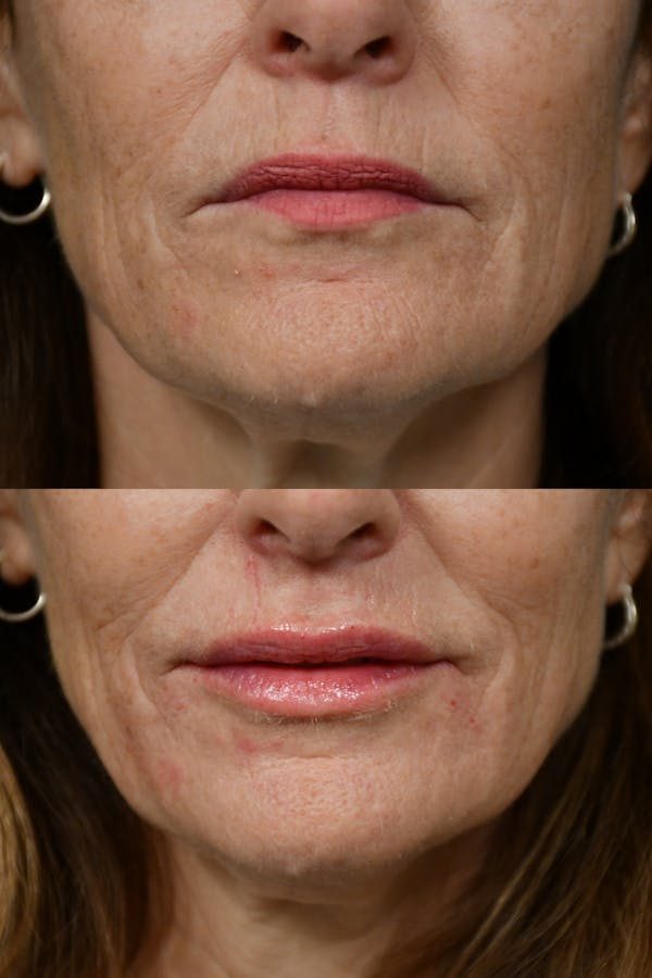 Injectables Before & After Gallery - Patient 172208 - Image 1