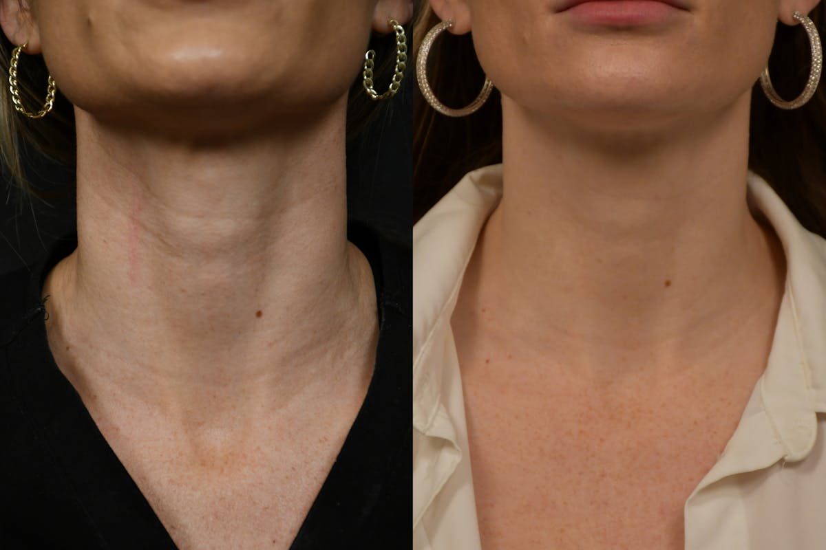Jawline/Chin Before & After Gallery - Patient 270105 - Image 2