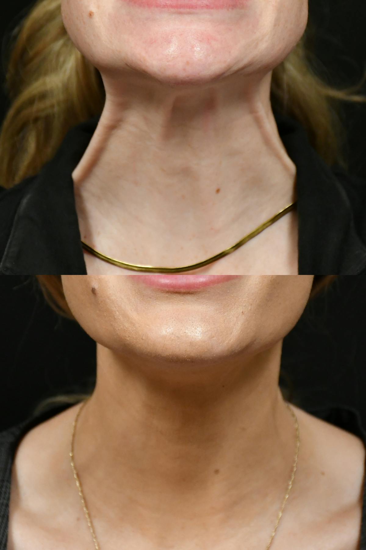 Jawline/Chin Before & After Gallery - Patient 270105 - Image 3