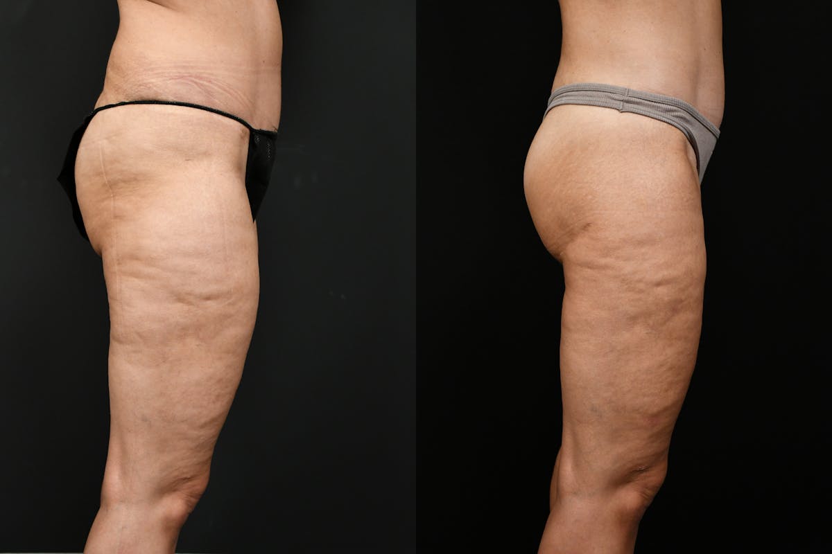 Butt Augmentation Before & After Gallery - Patient 251812 - Image 2