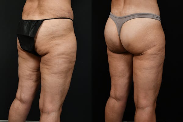 Butt Augmentation Before & After Gallery - Patient 251812 - Image 1