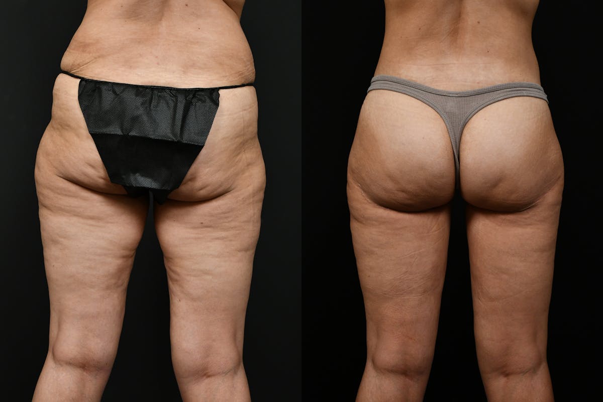Butt Augmentation Before & After Gallery - Patient 251812 - Image 3