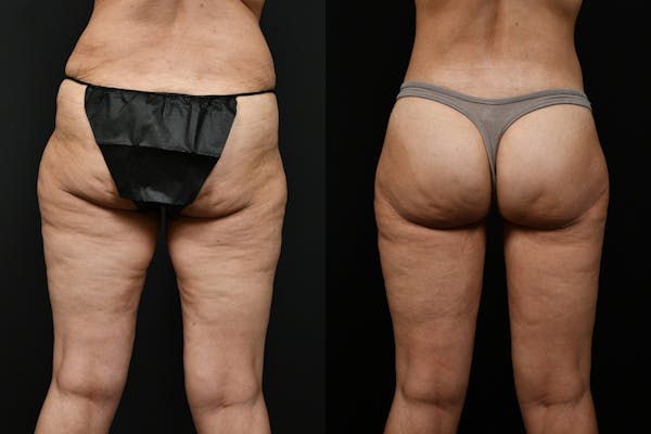 Thigh Lift Before & After Gallery - Patient 539353 - Image 1