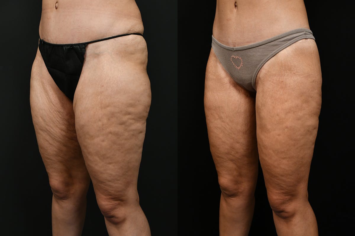 Thigh Lift Before & After Gallery - Patient 539353 - Image 7