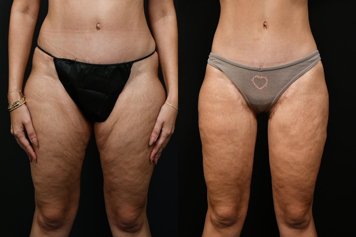 Thigh Lift Before & After Gallery - Patient 539353 - Image 8