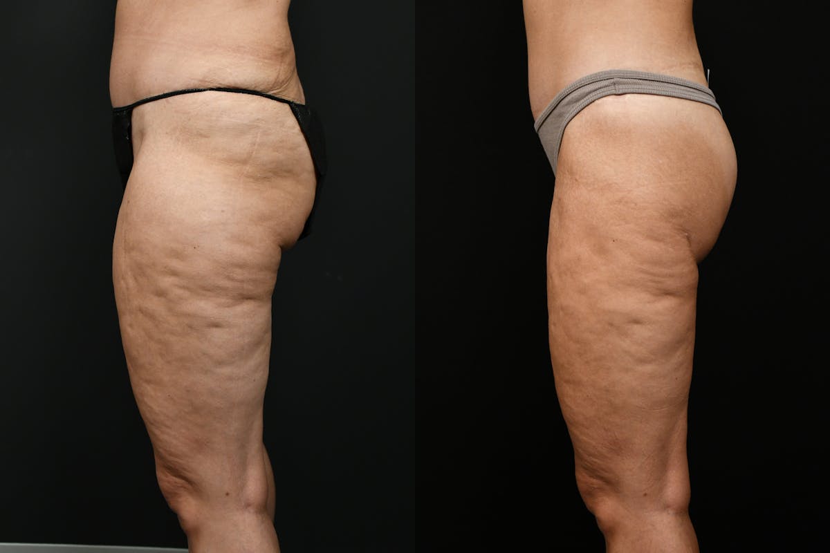 Butt Augmentation Before & After Gallery - Patient 251812 - Image 5