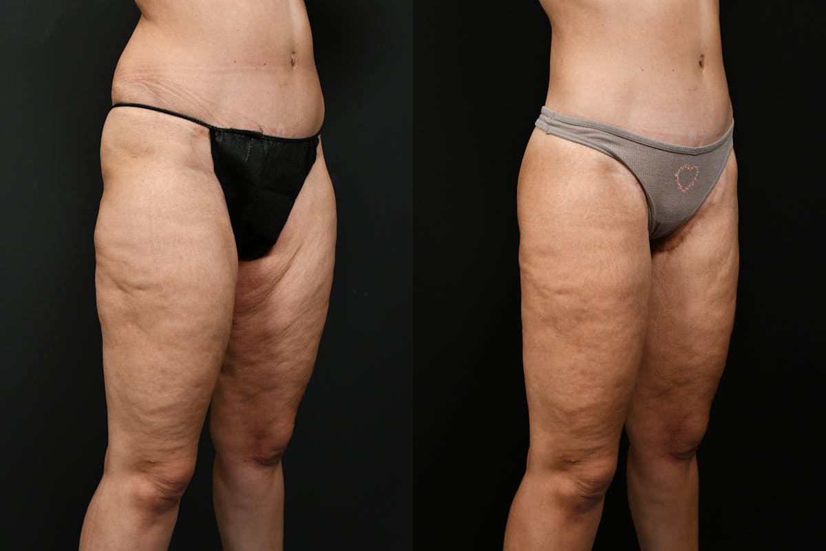 Thigh Lift Before & After Gallery - Patient 539353 - Image 2
