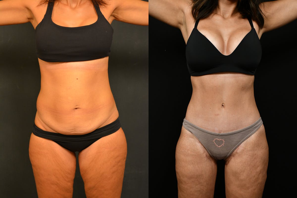 Massive Weight Loss Before & After Gallery - Patient 907791 - Image 1
