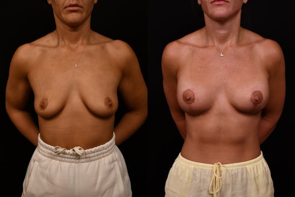 Reductive Augmentation Before & After Gallery - Patient 427275 - Image 1