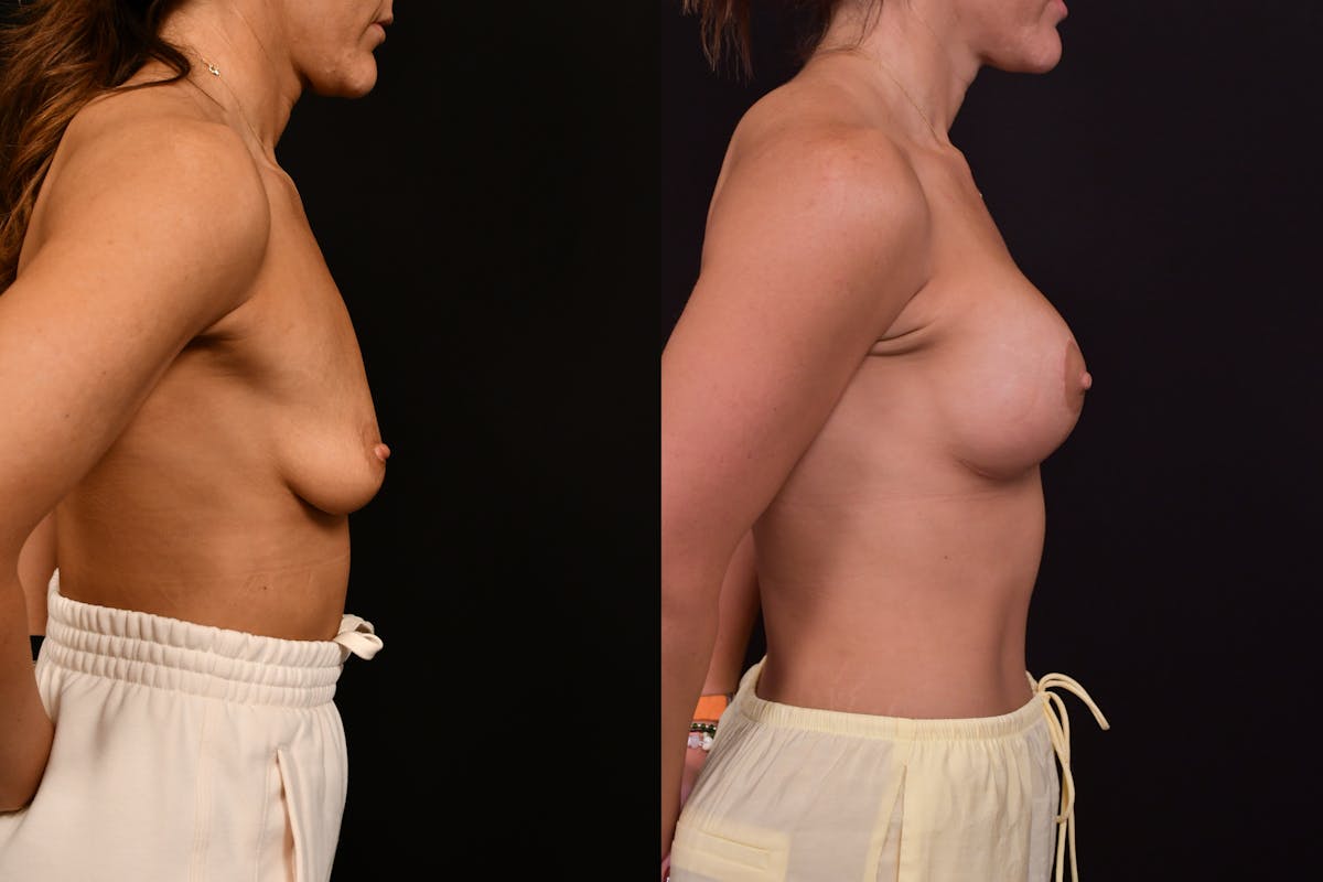 Reductive Augmentation Before & After Gallery - Patient 427275 - Image 5