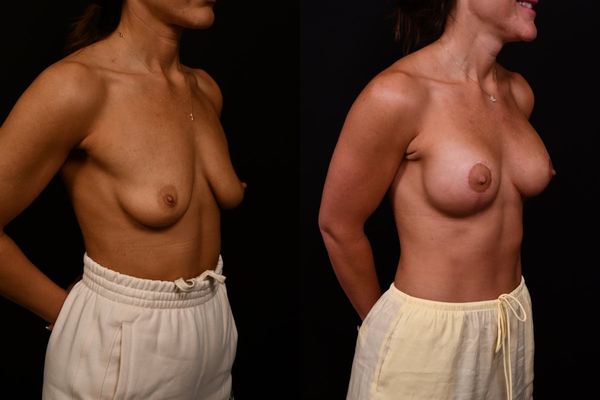 Reductive Augmentation Before & After Gallery - Patient 427275 - Image 4