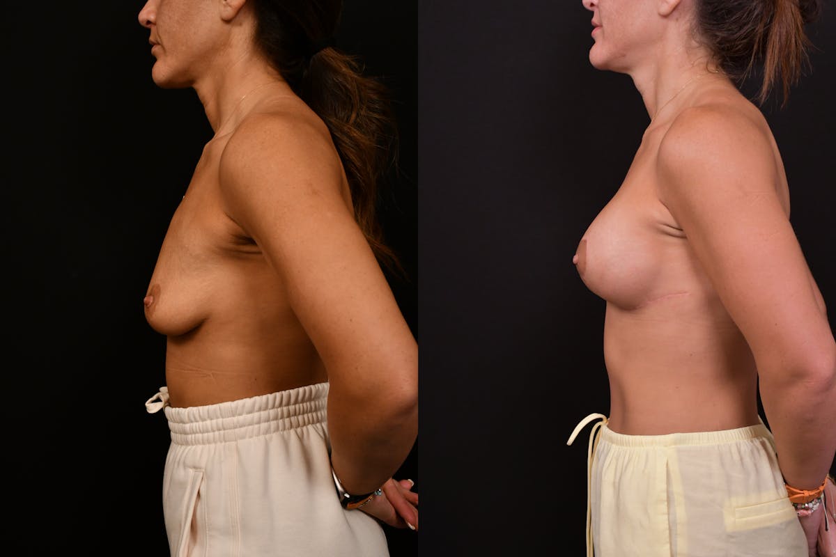 Reductive Augmentation Before & After Gallery - Patient 427275 - Image 3