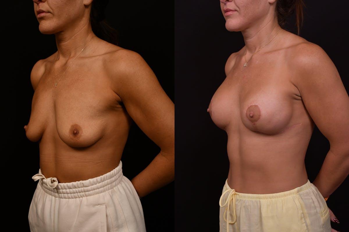 Reductive Augmentation Before & After Gallery - Patient 427275 - Image 2