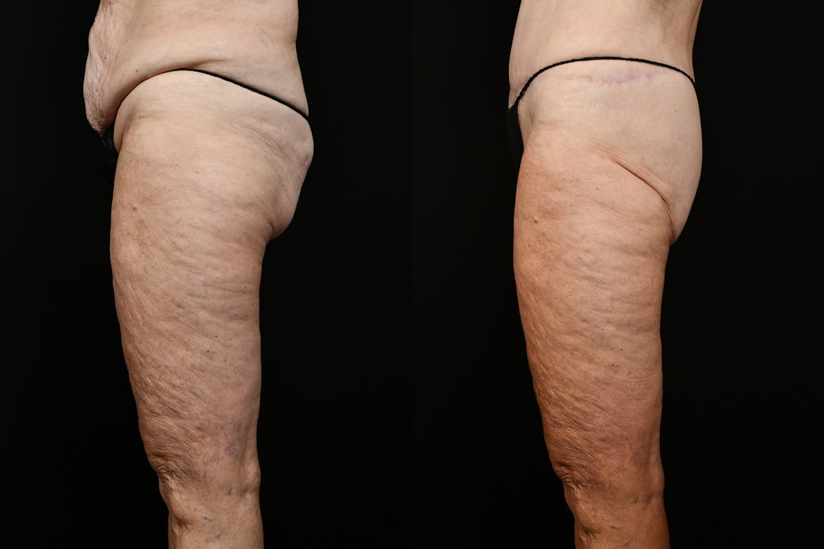 Thigh Lift Before & After Gallery - Patient 468934 - Image 3
