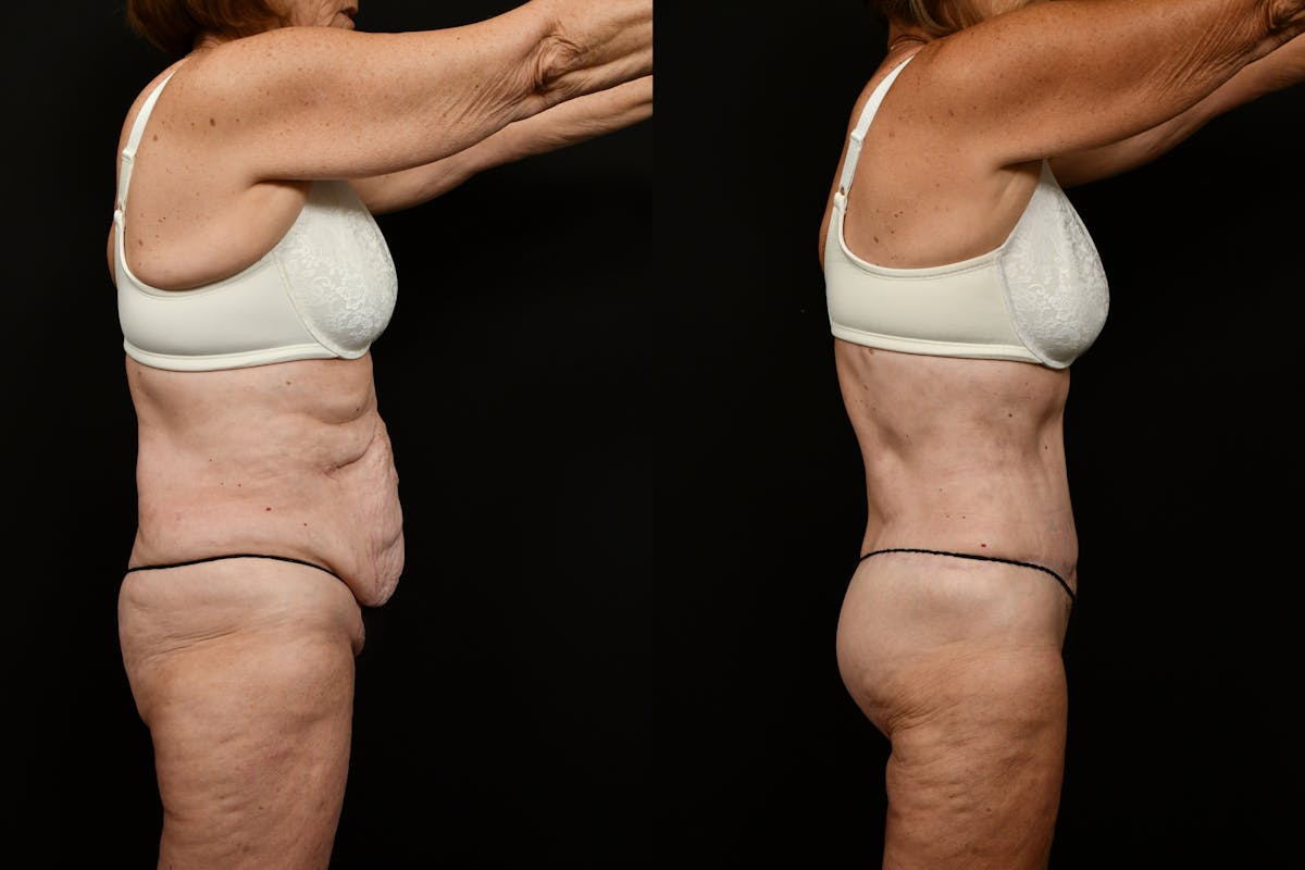 Tummy Tuck Before & After Gallery - Patient 258196 - Image 3