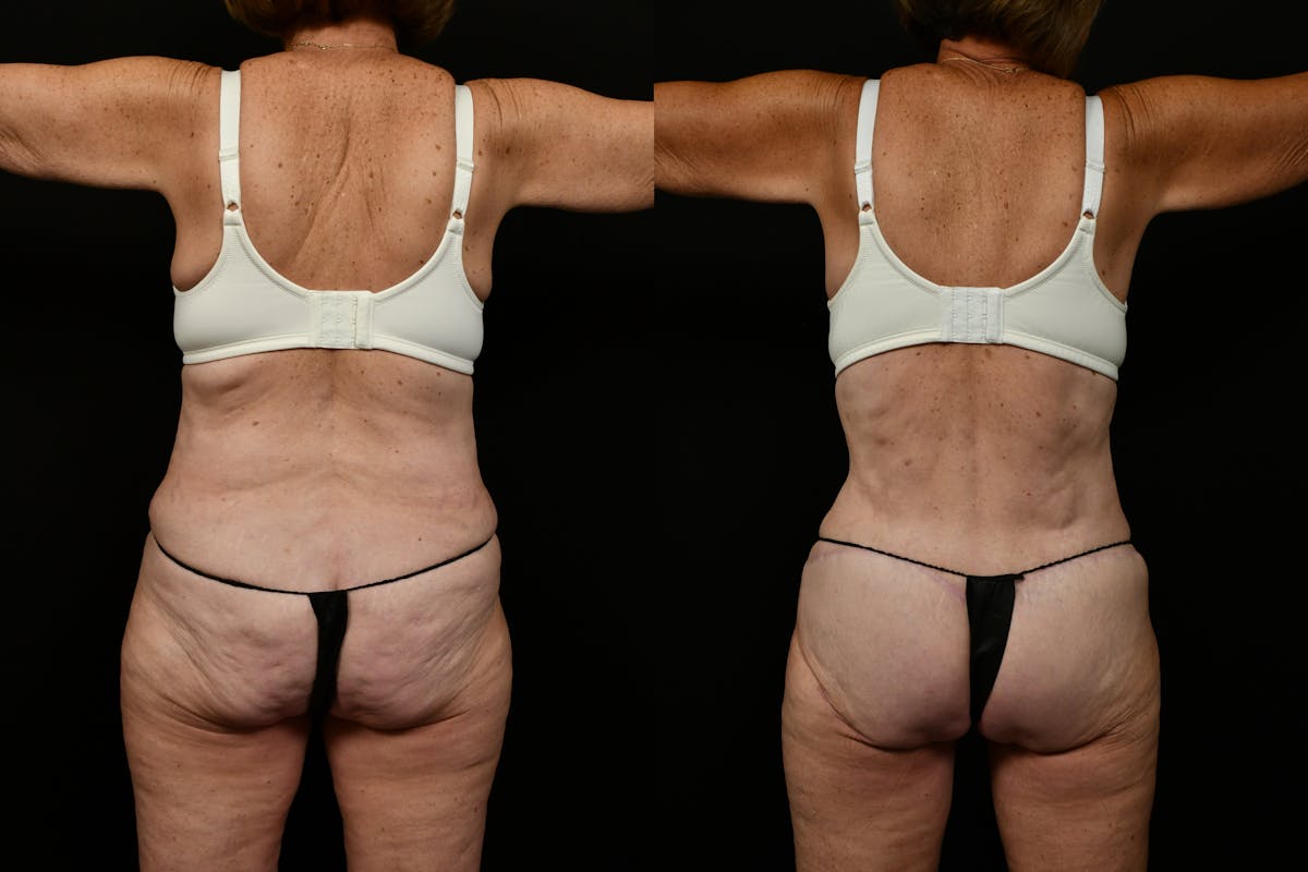 Tummy Tuck Before & After Gallery - Patient 258196 - Image 5