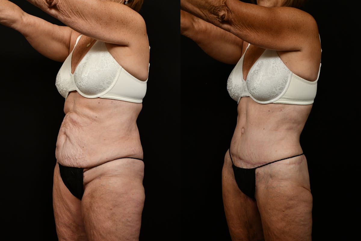 Tummy Tuck Before & After Gallery - Patient 258196 - Image 8