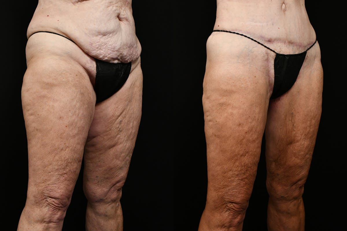 Thigh Lift Before & After Gallery - Patient 468934 - Image 6
