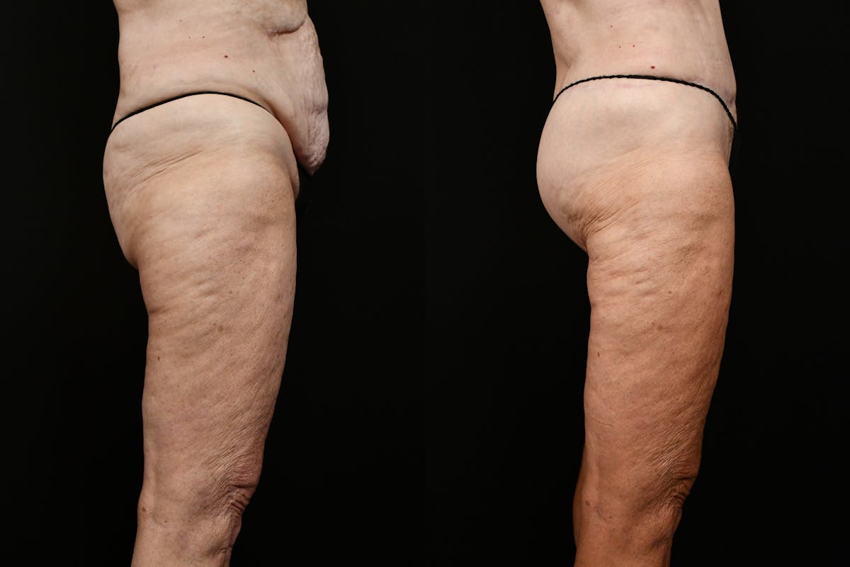 Thigh Lift Before & After Gallery - Patient 468934 - Image 7