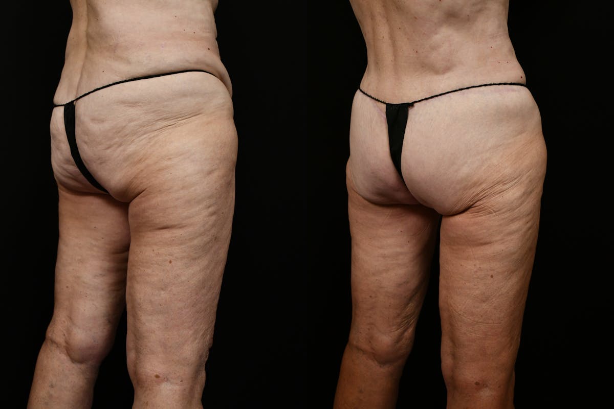 Thigh Lift Before & After Gallery - Patient 468934 - Image 8