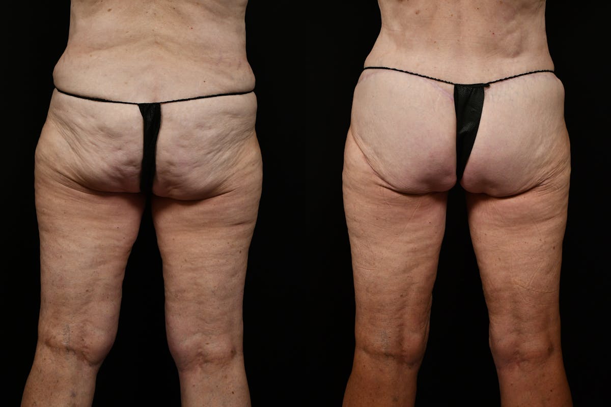 Thigh Lift Before & After Gallery - Patient 468934 - Image 1