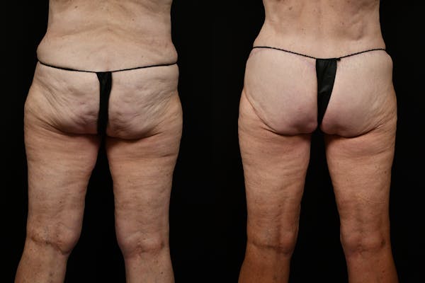 Thigh Lift Before & After Gallery - Patient 468934 - Image 1